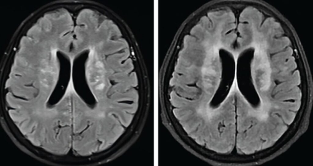 Mutfaktaki basit bir hata sonucu beynini kurtlar sardı