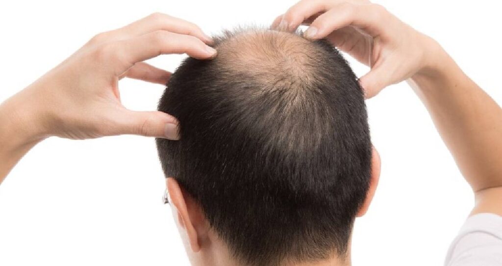 Saç dökülmesini engelliyor kellik tarihe karışıyor