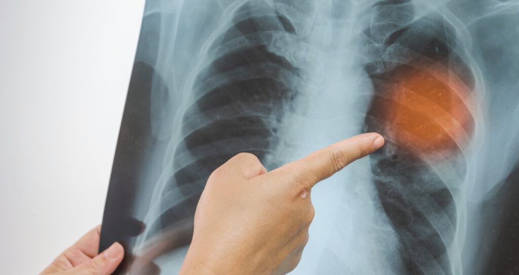 Hemen hastaneye gitmenizi gerektiren zatürre belirtileri