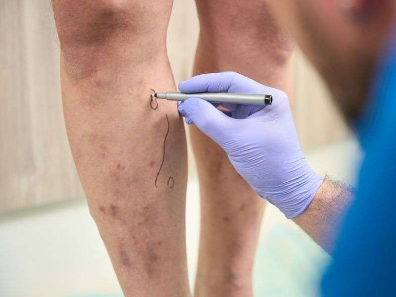 Varis Nedir? Nasıl Tedavi Edilir?